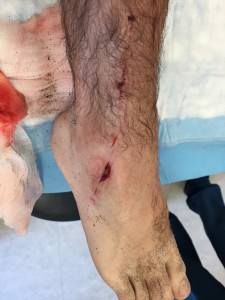 Josh Green received 18 stitches after an apparent shark bite