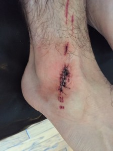 Josh Green received 18 stitches after an apparent shark bite